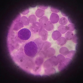 Lesión neoplásica de células redondas