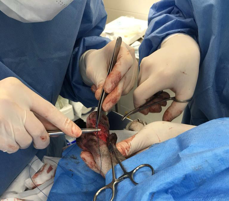 Tratamiento quirúrgico: amputación de la falange 