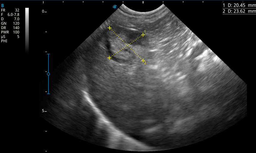 Diagnóstico neoplasia