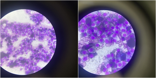 células redondas con marcada anisocitosis y anisocariosis